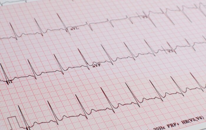 ECG appointment showing heart rhythms on a medical monitor in a clinical setting.