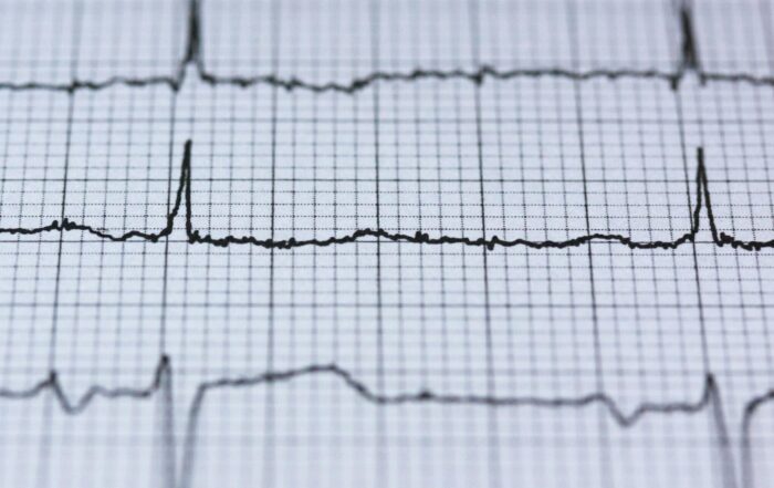 Normal ECG Reading Explained Essential Insights Everyone Needs to Know ECG