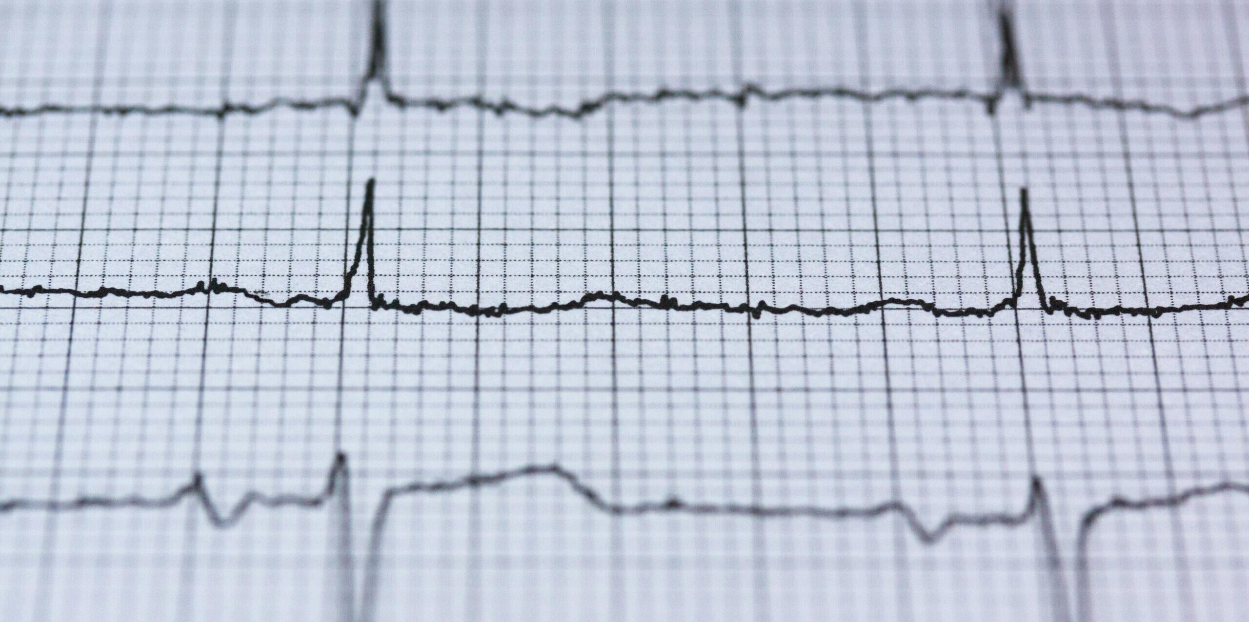 Normal ECG Reading Explained Essential Insights Everyone Needs to Know ECG Normal ECG Reading Explained Essential Insights Everyone Needs to Know ECG